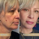 Facelift Vorher-Nachher-Ergebnisse in der Dr. Safa Manav Klinik, sichtbare Verjüngung