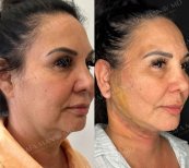 Facelift Vorher-Nachher-Ergebnisse bei Dr. Safa Manav Clinic, sichtbare Kiefer- und Halsstraffung
