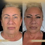 Facelift Vorher-Nachher-Ergebnisse in der Dr. Safa Manav Klinik, sichtbare Verjüngung