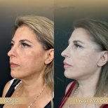 Facelift Vorher-Nachher-Ergebnisse bei Dr. Safa Manav Clinic, sichtbare Verjüngung