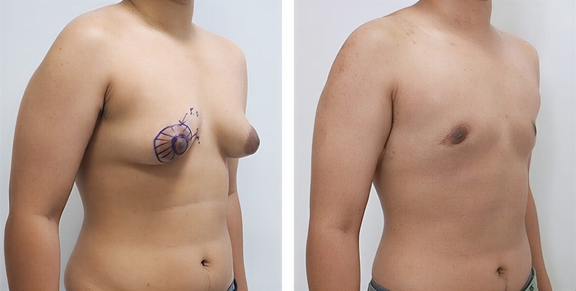 Resultados de cirugía FTM antes y después en Asia Cosmetic Hospital, masculinización torácica