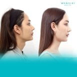 Before and after Adam's apple surgery results at Wansiri Hospital, visible neck contour change