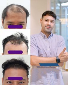 Efekty przeszczepu włosów przed i po w Vital Glow Skin & Aesthetic w Navamin 9 Hospital