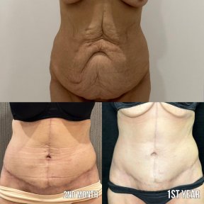 Результати до і після абдомінопластики та ліпосакції в клініці Dr. Safa Manav, контур живота