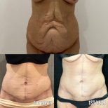 Результати до і після абдомінопластики та ліпосакції в клініці Dr. Safa Manav, контур живота
