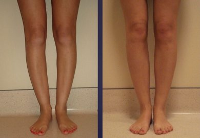 Before and after calf implants at Memorial Ataşehir Hospital, enhanced lower leg contour result
