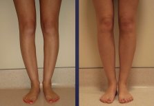 Before and after calf implants at Memorial Ataşehir Hospital, enhanced lower leg contour result