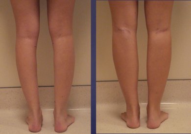 Before and after calf implants at Memorial Ataşehir Hospital, enhanced lower leg contour result