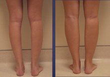 Before and after calf implants at Memorial Ataşehir Hospital, enhanced lower leg contour result