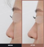 نتائج قبل وبعد عملية تصحيح الحاجز الأنفي في URBAN Plastic Surgery وتحسن شكل الأنف