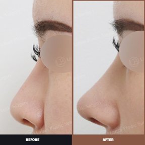نتائج قبل وبعد عملية تصحيح الحاجز الأنفي في URBAN Plastic Surgery وتحسن شكل الأنف