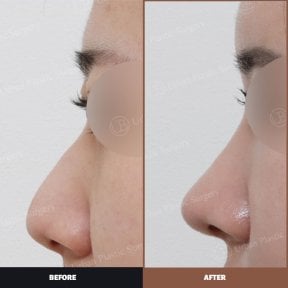 نتائج قبل وبعد لعملية تصحيح انحراف الحاجز الأنفي في URBAN Plastic Surgery