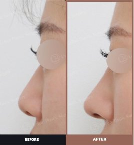 Vorher-nachher-Ergebnis Alarplastik bei URBAN Plastic Surgery, verbesserte Nasenform