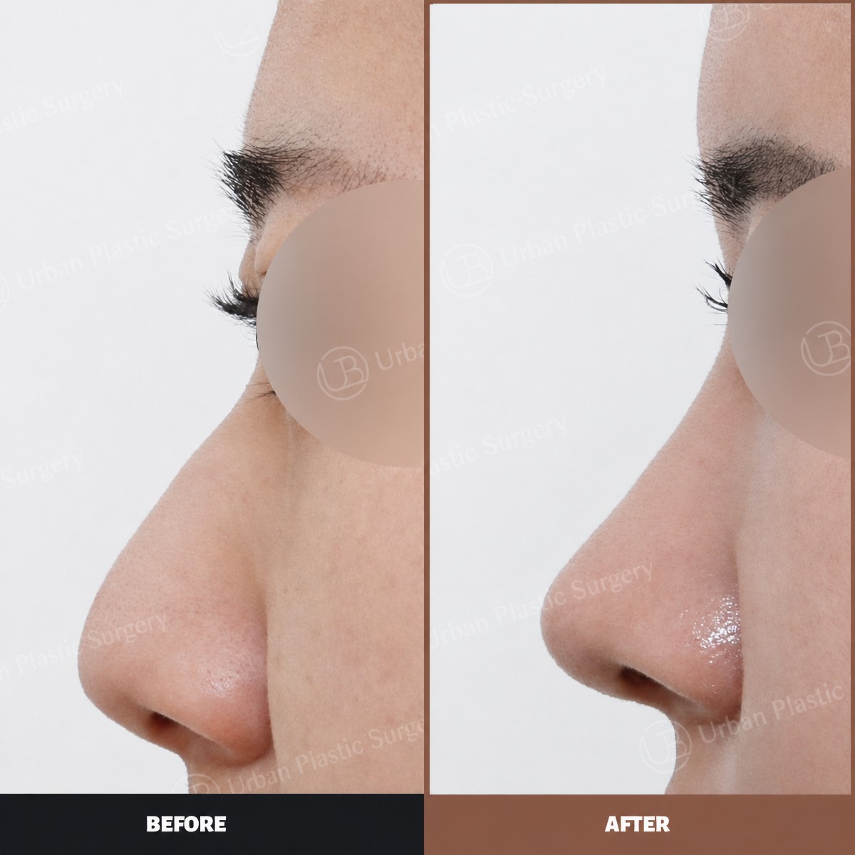 Resultados antes y después de alarplastia en URBAN Plastic Surgery, mejora de la forma nasal