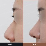 Vorher-nachher-Ergebnis Alarplastik bei URBAN Plastic Surgery, verbesserte Nasenform