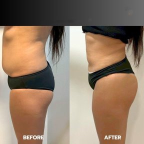 Before and after Brazilian Butt Lift results at ID Clinic Bangkok, enhanced body contour