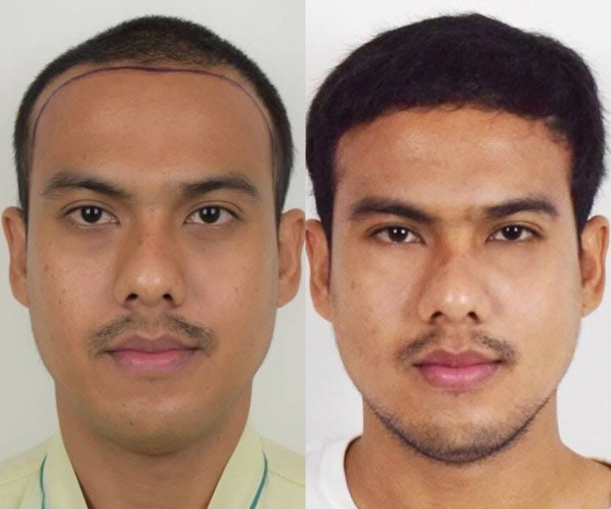 Vorher-nachher-Ergebnis Haartransplantation bei Vital Glow Skin & Aesthetic im Navamin 9 Hospital