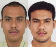 Efekty przeszczepu włosów przed i po w Vital Glow Skin & Aesthetic w Navamin 9 Hospital