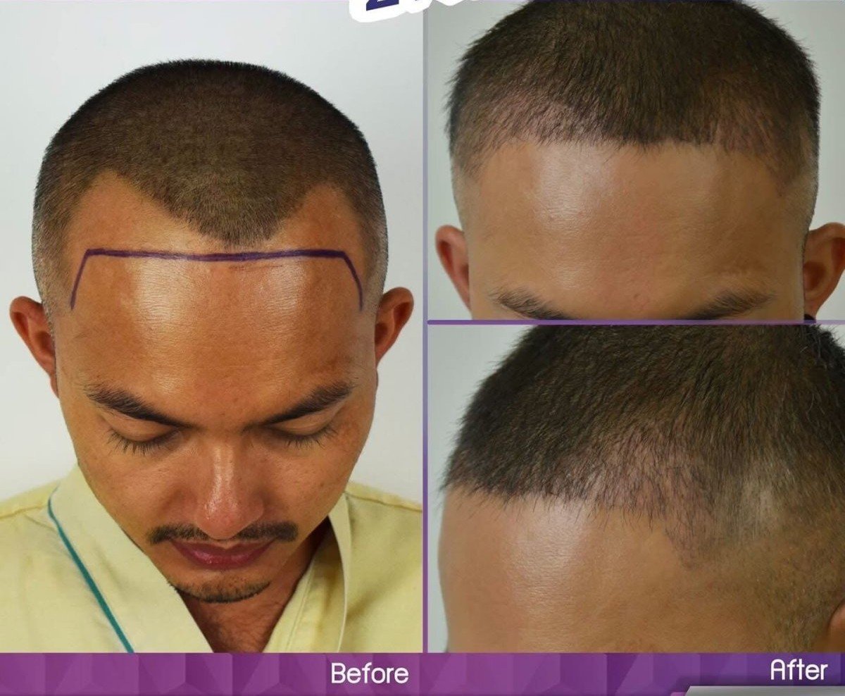 Vorher-nachher-Ergebnisse der Haartransplantation bei Vital Glow Skin & Aesthetic im Navamin 9 Hospital