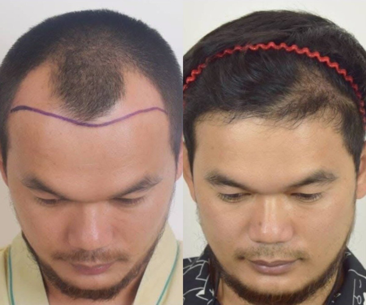 Vorher-nachher-Ergebnis Haartransplantation bei Vital Glow Skin & Aesthetic, verbesserter Haaransatz