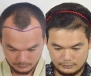 Efekty przeszczepu włosów przed i po w Vital Glow Skin & Aesthetic, poprawiona linia włosów