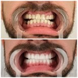 Resultados antes y después de smile makeover en YEG Clinic – alineación y color mejorados