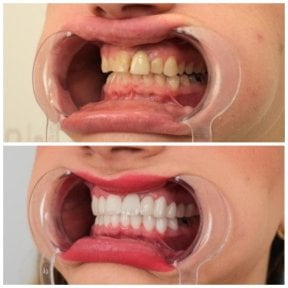 До и после smile makeover в YEG Clinic, виниры для белых и ровных зубов, результат