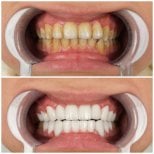 До и после преображения улыбки в YEG Clinic, результат виниров для белых зубов