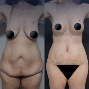 Before and after breast lift and tummy tuck results at Dr. Safa Manav Clinic, body contouring