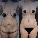 Before and after breast lift and tummy tuck results at Dr. Safa Manav Clinic, body contouring