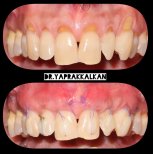 نتائج قبل وبعد جراحة اللثة في Esthetic Smile Academy، تحسين مظهر خط اللثة