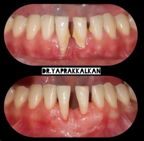 نتائج قبل وبعد جراحة اللثة في Esthetic Smile Academy – تحسن صحة ومظهر اللثة