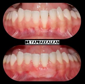 نتائج قبل وبعد جراحة اللثة في Esthetic Smile Academy، تحسين صحة وشكل اللثة