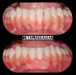 نتائج قبل وبعد جراحة اللثة في Esthetic Smile Academy، تحسين صحة وشكل اللثة