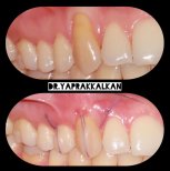 نتائج قبل وبعد جراحة اللثة في Esthetic Smile Academy، تحسين صحة وشكل اللثة