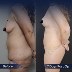 Before and after breast lift and tummy tuck results at Dr. Safa Manav Clinic, 7 days post-op