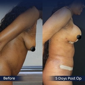 Before and after breast lift results at Dr. Safa Manav Clinic, visible lift and contour improvement