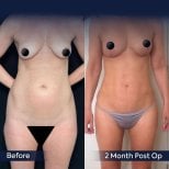 Vorher-nachher-Ergebnis Bauchdeckenstraffung und Fettabsaugung bei Dr. Safa Manav Clinic