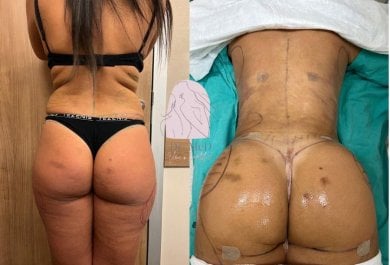 Before and after lipofilling (fat grafting) results at Dr. MED, enhanced buttock contour