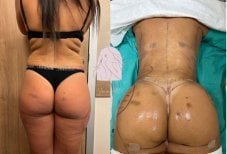 Before and after lipofilling (fat grafting) results at Dr. MED, enhanced buttock contour