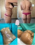 Before and after lipofilling (fat grafting) results at Dr. MED, body contour enhancement