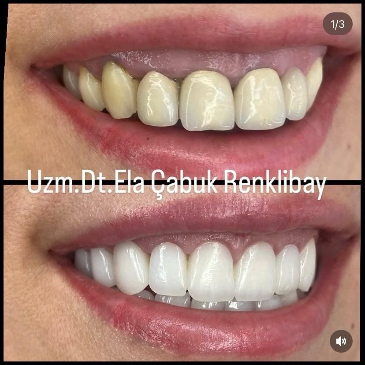 Resultados de antes y después de bonding dental en la clínica Dr. Ela Cabuk Renklibay