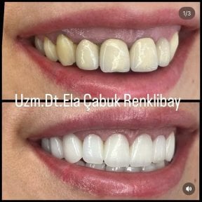Résultats avant/après bonding dentaire à la clinique Dr. Ela Cabuk Renklibay