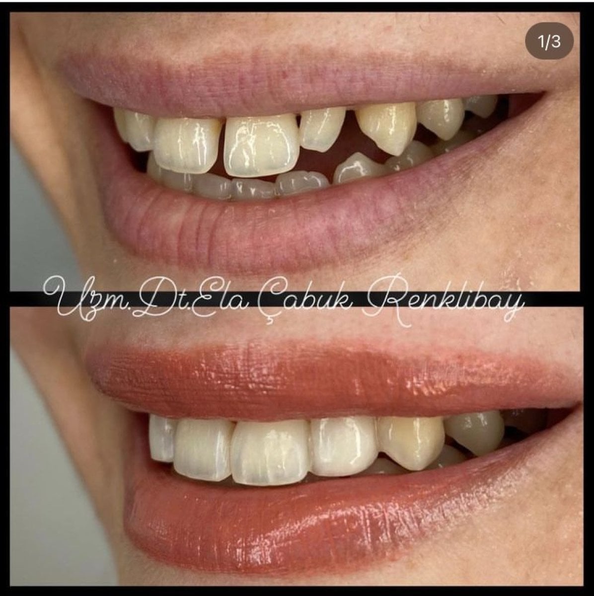 Resultados de antes y después de bonding dental en la clínica de la Dra. Ela Cabuk Renklibay