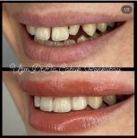 Результати до і після бондингу зубів у клініці доктора Ели Кабук Ренклібай