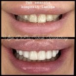 Resultados de bonding dental antes y después en la clínica Dr. Ela Cabuk Renklibay