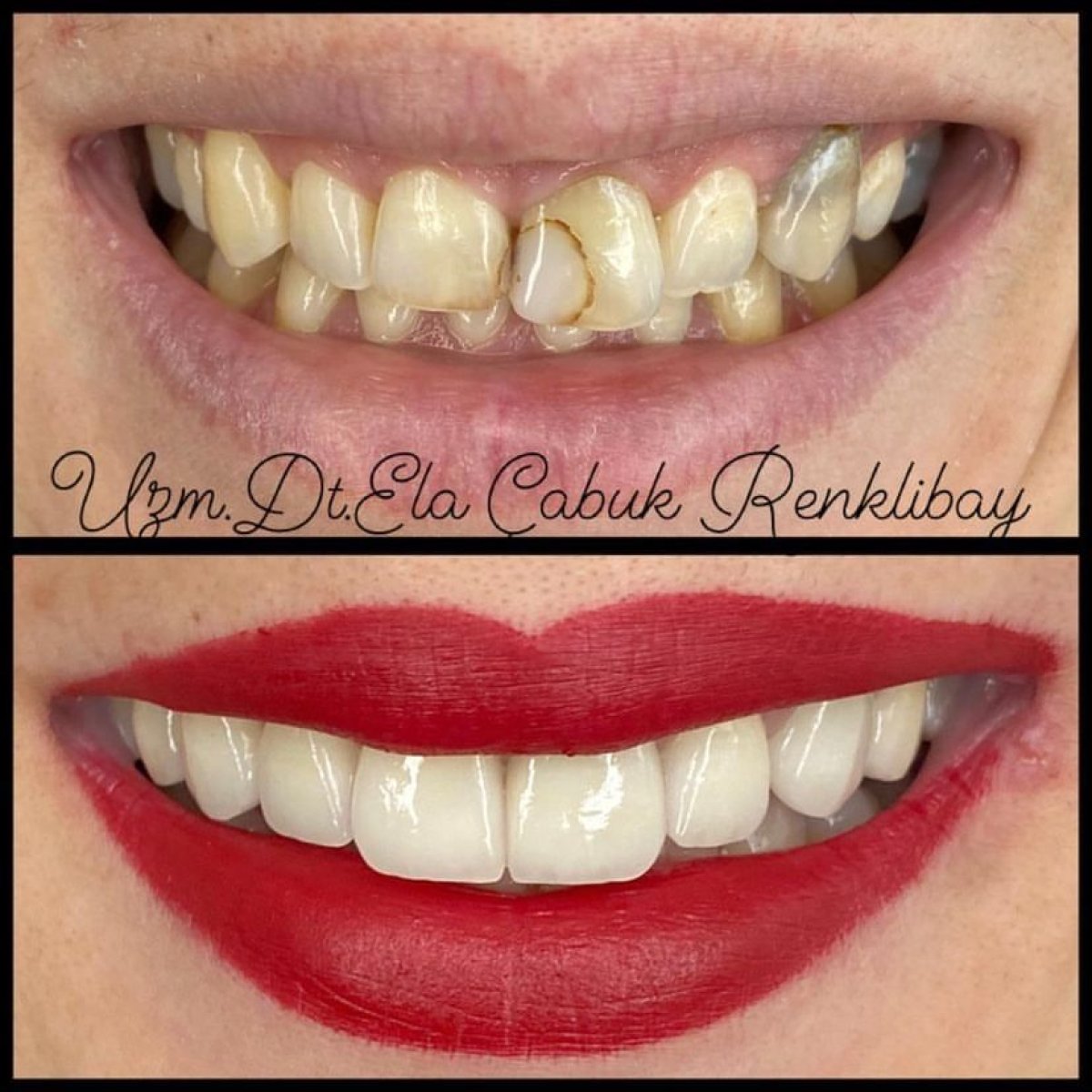 Resultados de antes y después de bonding dental en la clínica privada de la Dra. Ela Cabuk Renklibay