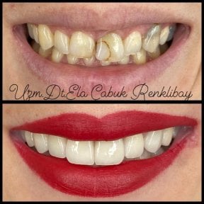 Resultados de antes y después de bonding dental en la clínica privada de la Dra. Ela Cabuk Renklibay