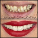 Resultados de antes y después de bonding dental en la clínica privada de la Dra. Ela Cabuk Renklibay