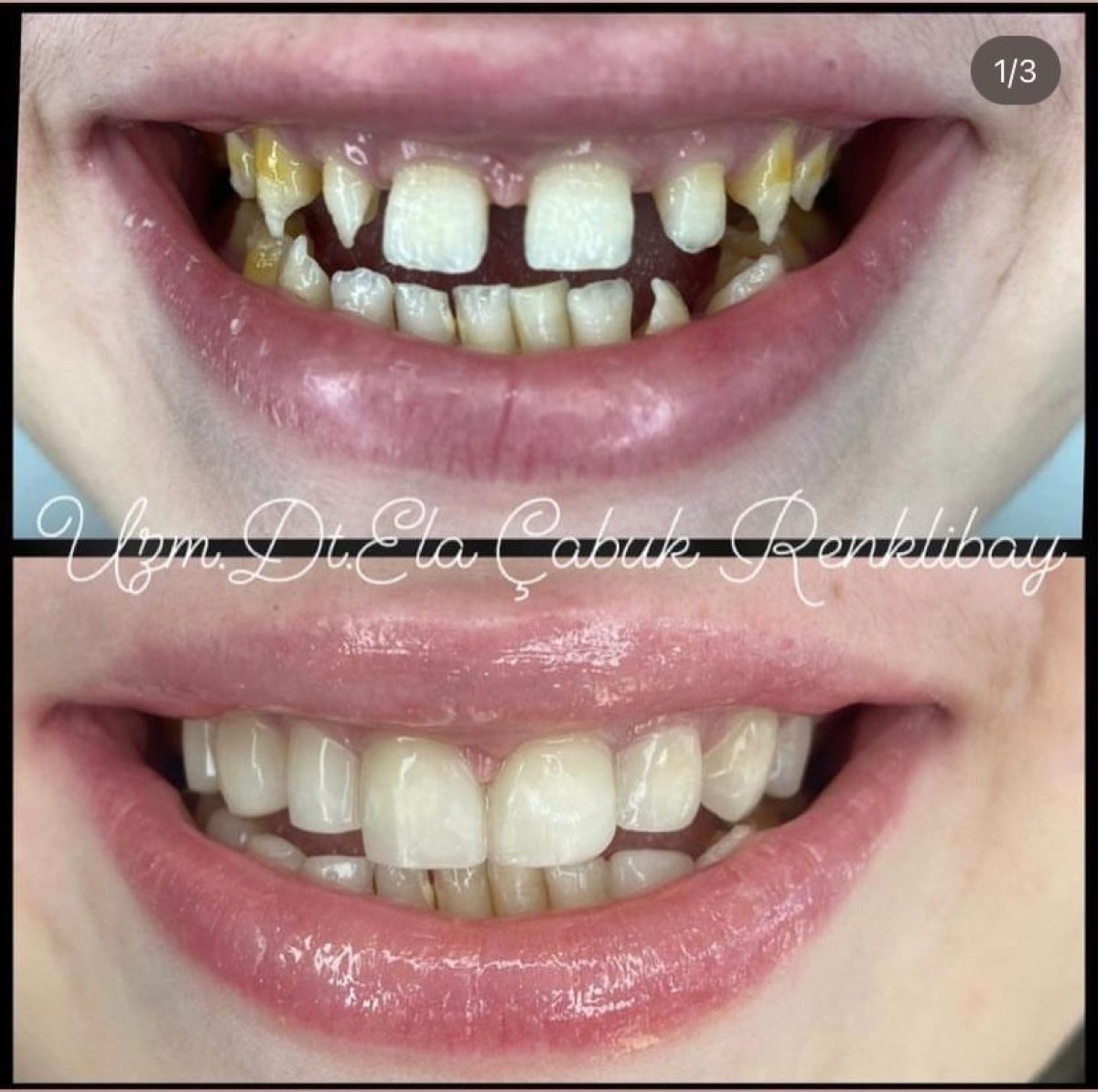 Résultats avant et après bonding dentaire à la clinique privée Dr Ela Cabuk Renklibay